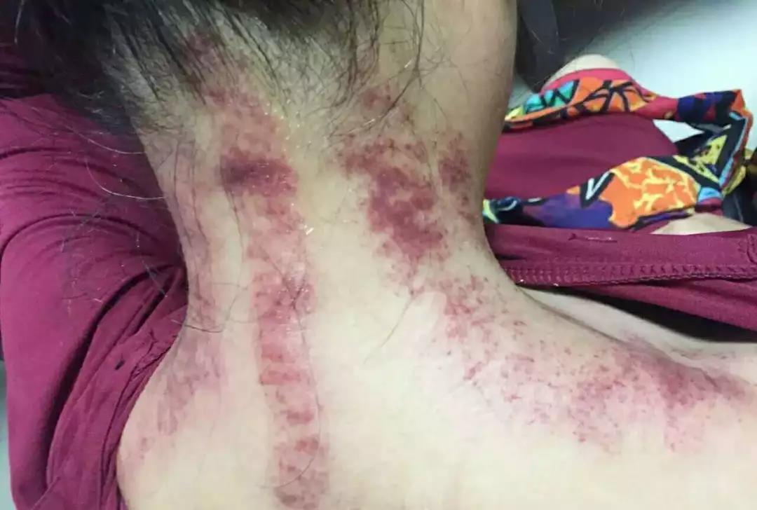 刮痧出红一定就是湿气重吗?专家却这么说